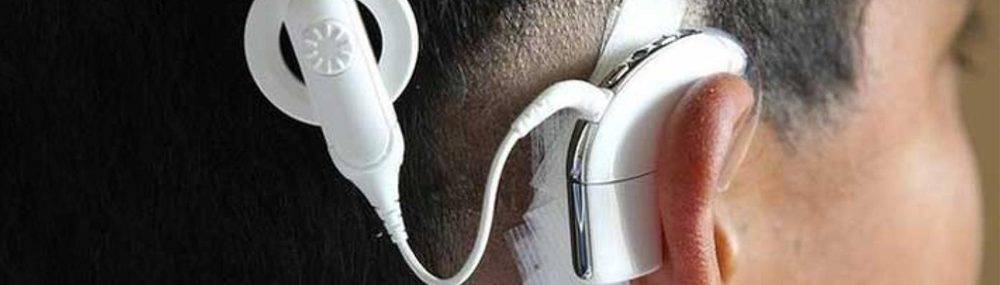 Cochlear Implant